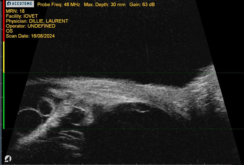 Echographie de l'oeil : Kystes ciliaires dans la chambre postérieure