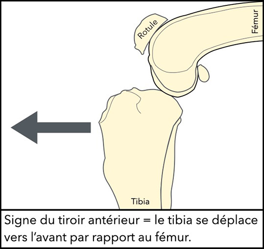 Schema du signe du tiroir antérieur