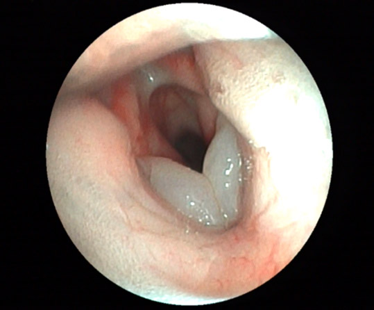 Photo endoscopie montrant une protrusion des ventricules laryngés dans la lumière du larynx, causant une obstruction des voies respiratoires chez un Boulegogue Anglais