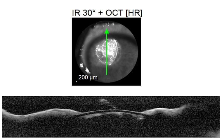 OCT iris chat