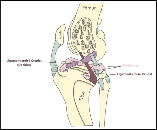 Schema d'une rupture de ligament croisé